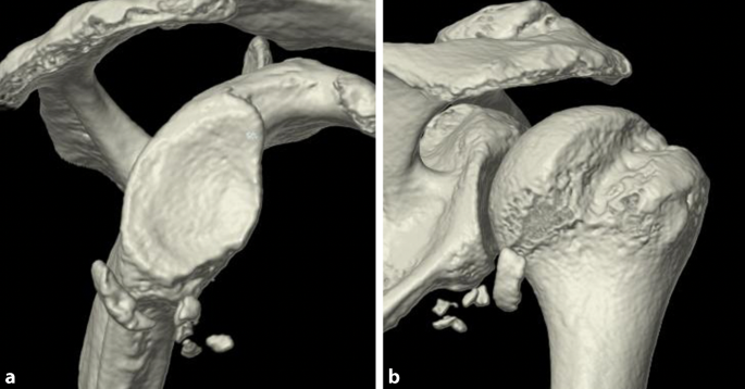Glenoid Deficit