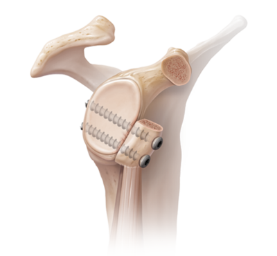 Lussazione anteriore di spalla