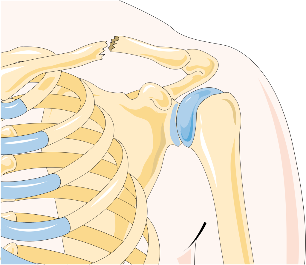 frattura della clavicola
